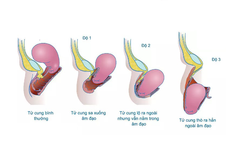 các cấp độ bệnh sa tử cung