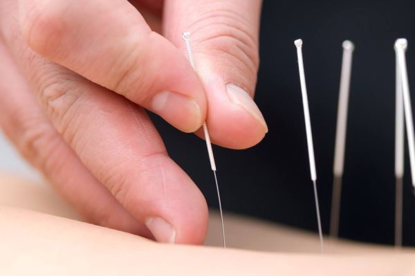 Chữa đau thần kinh tọa bằng châm cứu có khỏi hoàn toàn không?