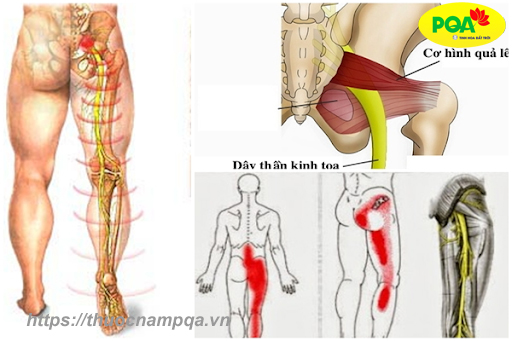 biến chứng đau thần kinh tọa gây teo cơ