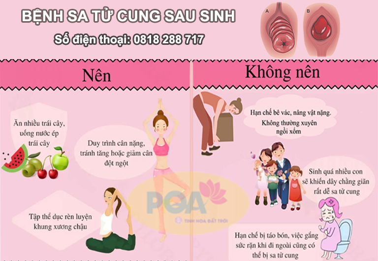 Sa tử cung cần hạn chế làm gì và nên làm gì