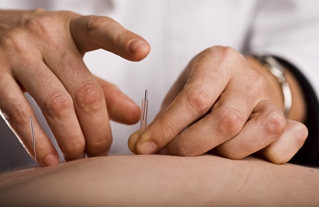 châm cứu chữa đau thần kinh tọa