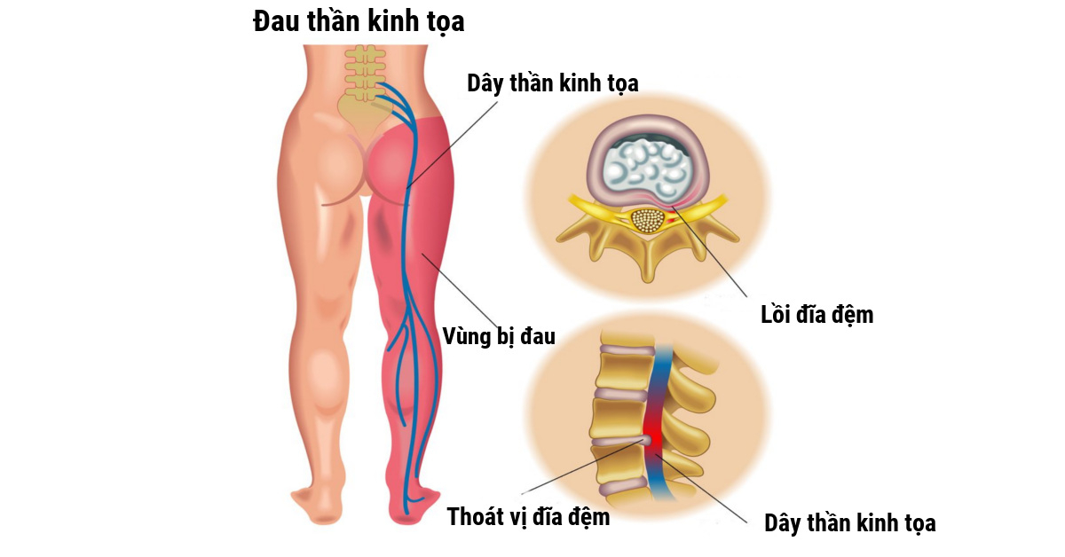 đau dây thần kinh tọa
