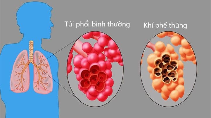 bệnh hen suyễn dẫn đến khí phế thũng