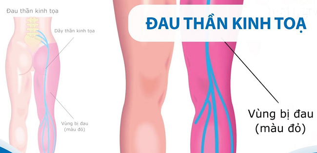 bệnh thần kinh tọa kiêng ăn gì