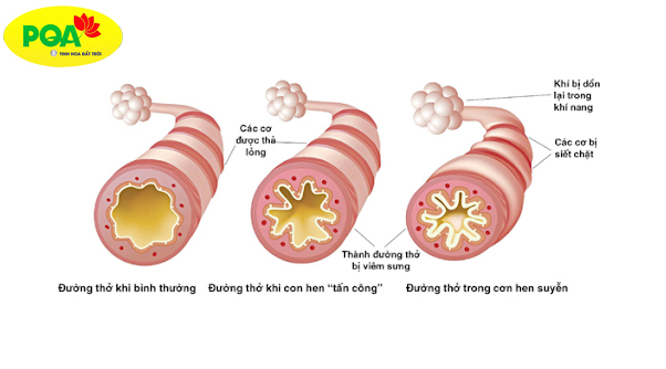 đường thở khi bị hen suyễn