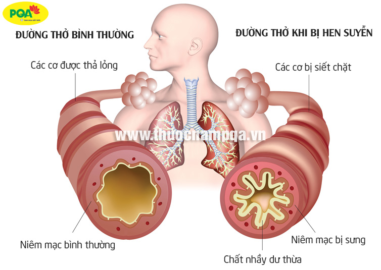 hen phế quản