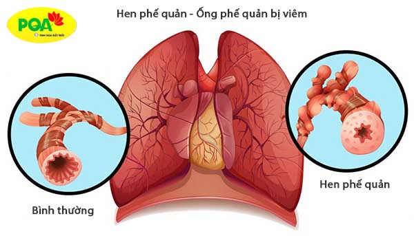 hình ảnh bệnh hen phế quản - hen suyễn