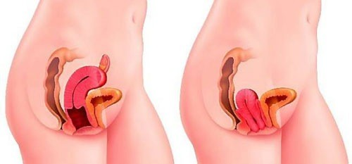 hình ảnh sa tử cung độ 2