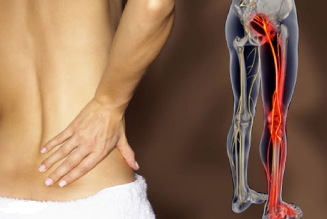 triệu chứng đau thần kinh tọa